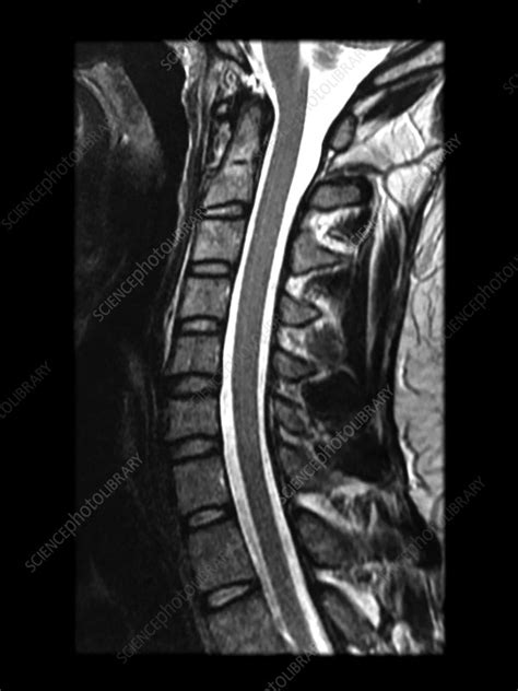 Normal cervical spine MRI .